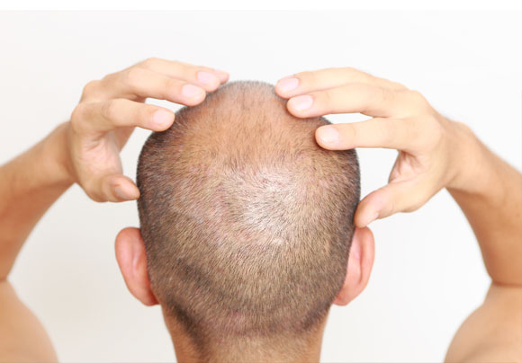 how to regrow hair on my forehead